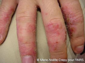 eczema mains